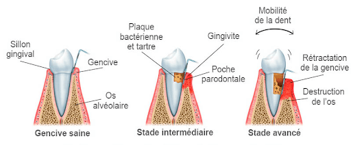 Différents stade des maladies parodontales
